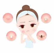 青春痘原因有哪些
